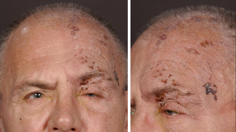 Herpes Zoster Oftalmika